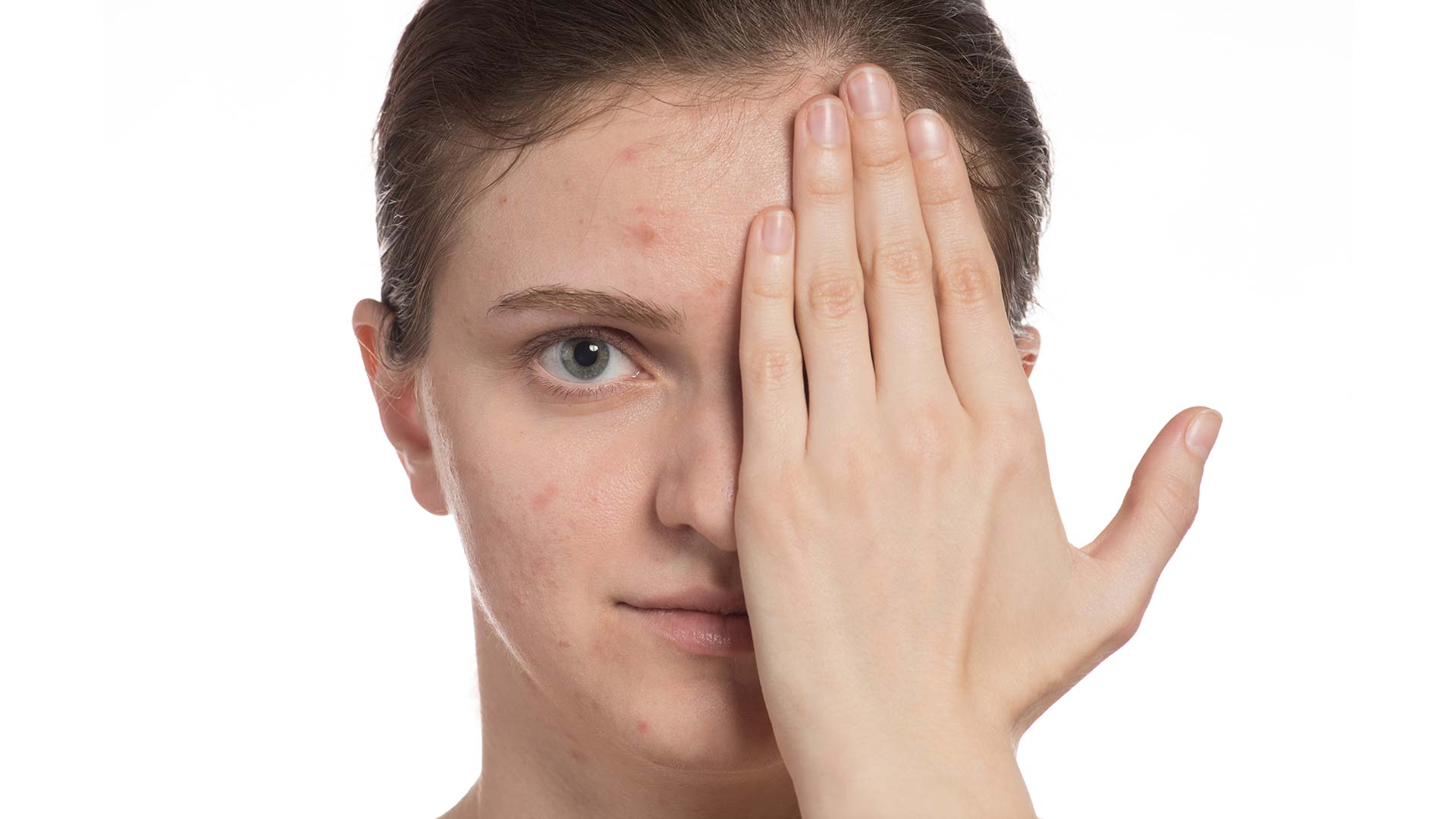 Ragaza con Acne utilizza crema alla bava di lumaca