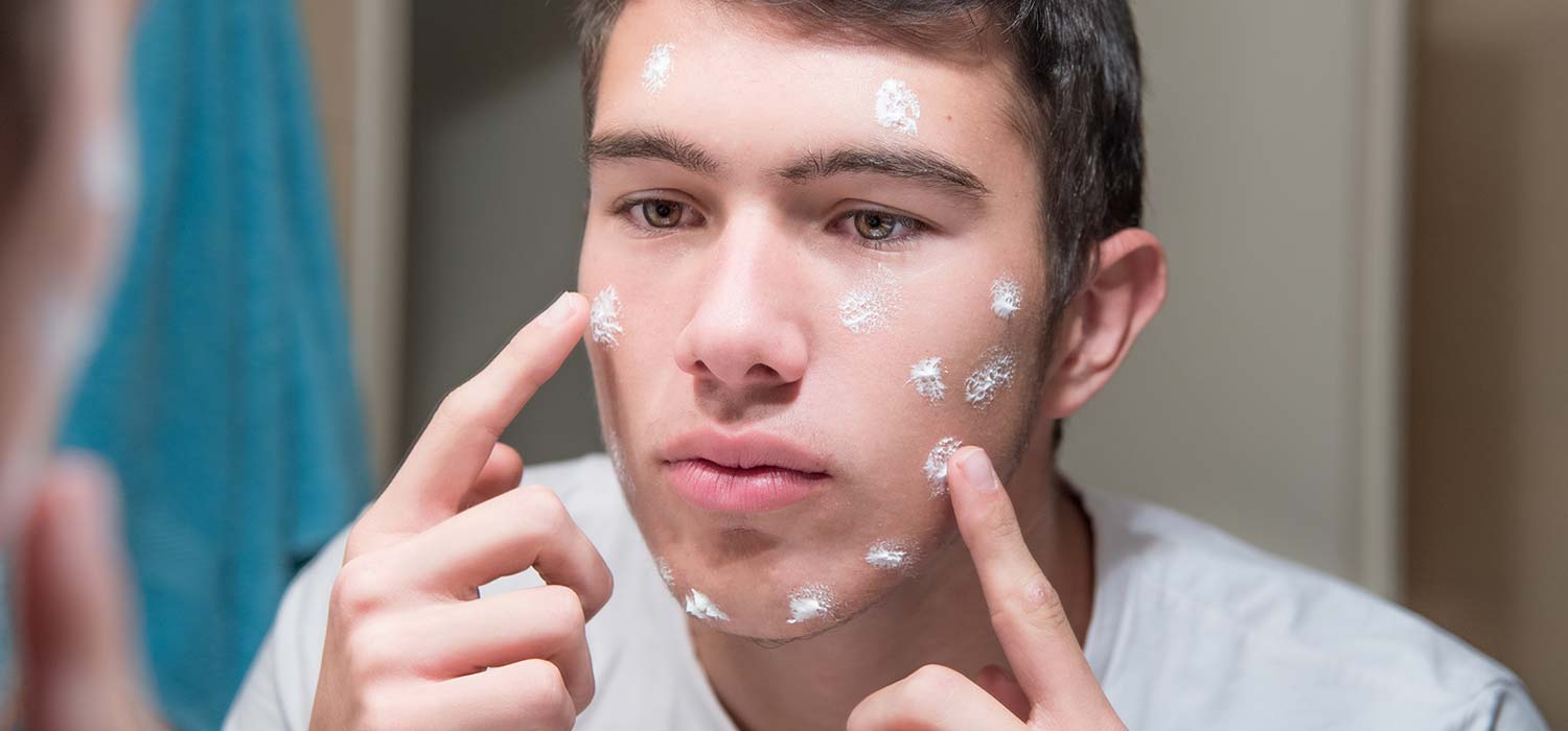 Bava di lumaca per acne
